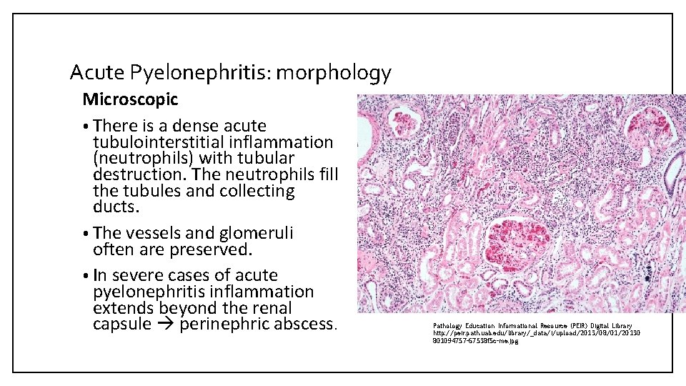 Acute Pyelonephritis: morphology Microscopic • There is a dense acute tubulointerstitial inflammation (neutrophils) with