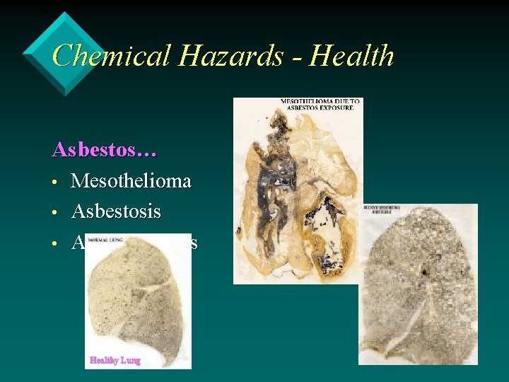 Chemical Hazards - Health Asbestos… • • • Mesothelioma Asbestosis Asbestos warts Healthy Lung