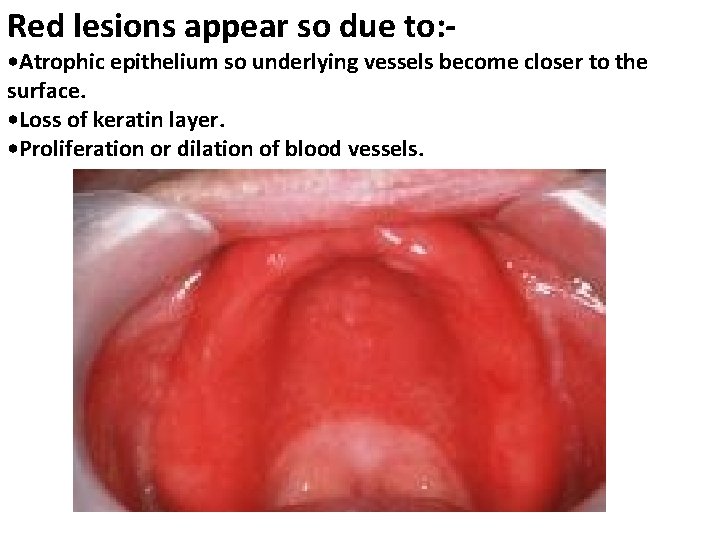 Red lesions appear so due to: - • Atrophic epithelium so underlying vessels become