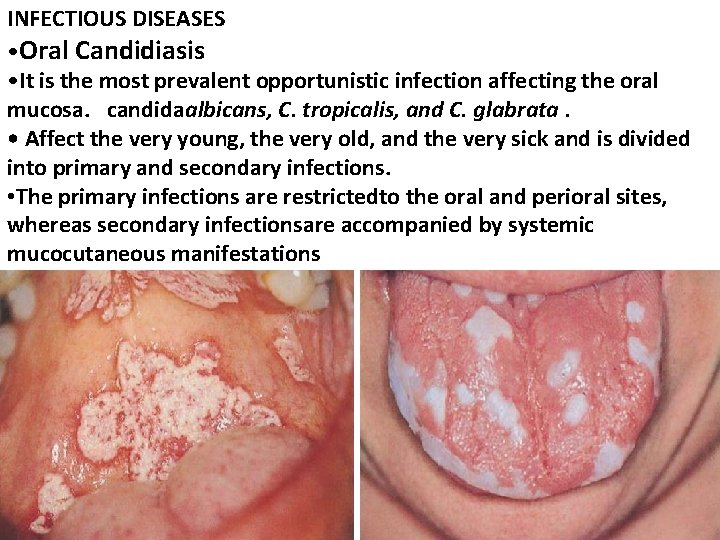 INFECTIOUS DISEASES • Oral Candidiasis • It is the most prevalent opportunistic infection affecting