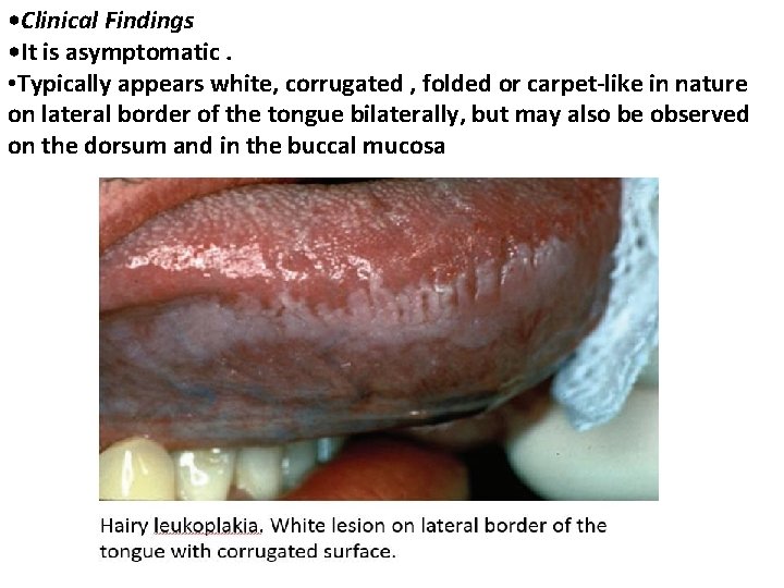  • Clinical Findings • It is asymptomatic. • Typically appears white, corrugated ,