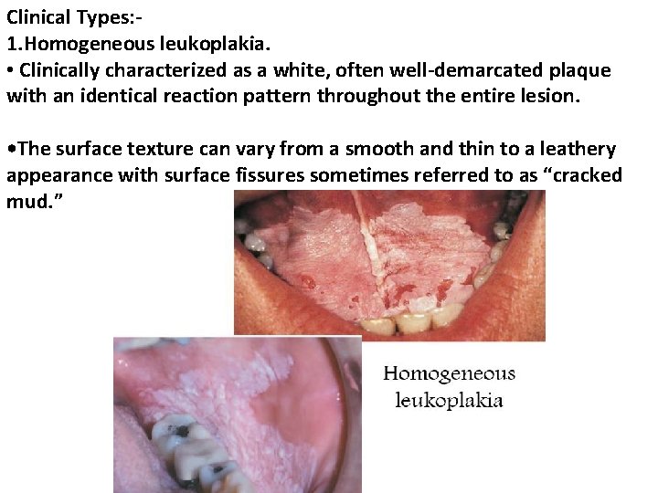 Clinical Types: 1. Homogeneous leukoplakia. • Clinically characterized as a white, often well-demarcated plaque