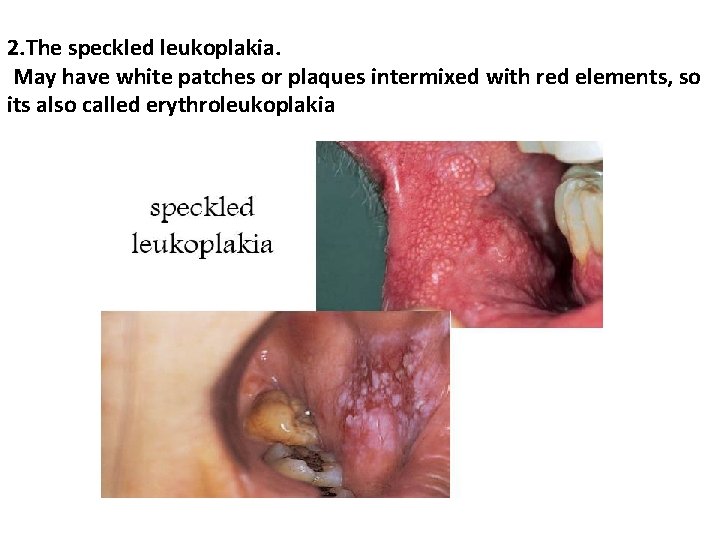 2. The speckled leukoplakia. May have white patches or plaques intermixed with red elements,