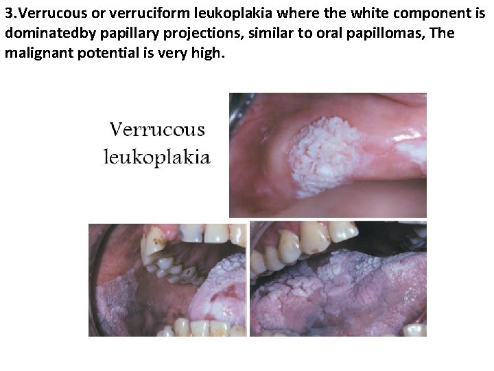 3. Verrucous or verruciform leukoplakia where the white component is dominatedby papillary projections, similar