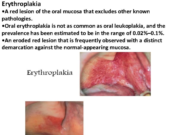 Erythroplakia • A red lesion of the oral mucosa that excludes other known pathologies.