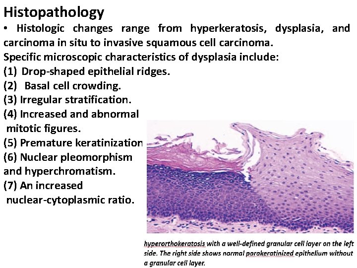 Histopathology • Histologic changes range from hyperkeratosis, dysplasia, and carcinoma in situ to invasive