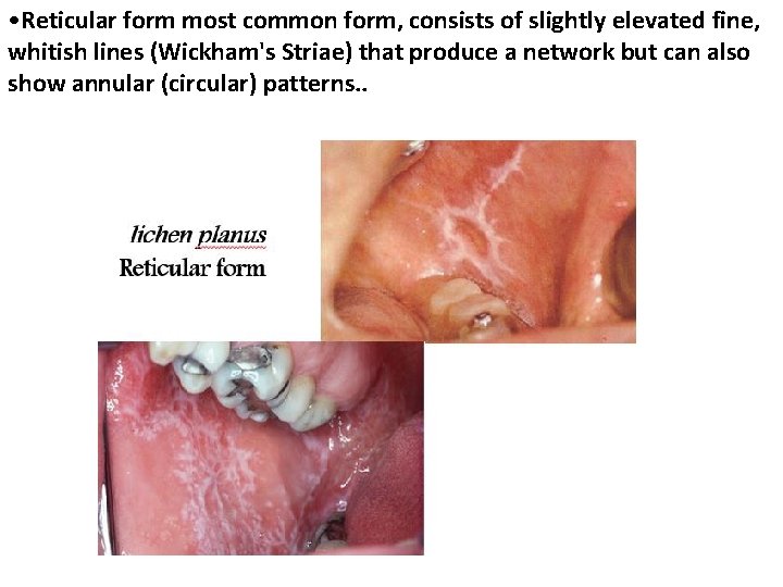  • Reticular form most common form, consists of slightly elevated fine, whitish lines