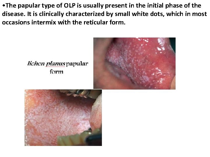  • The papular type of OLP is usually present in the initial phase