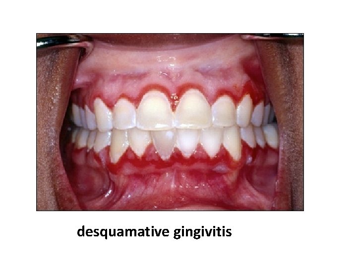 desquamative gingivitis 