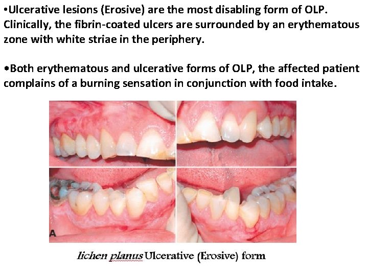  • Ulcerative lesions (Erosive) are the most disabling form of OLP. Clinically, the