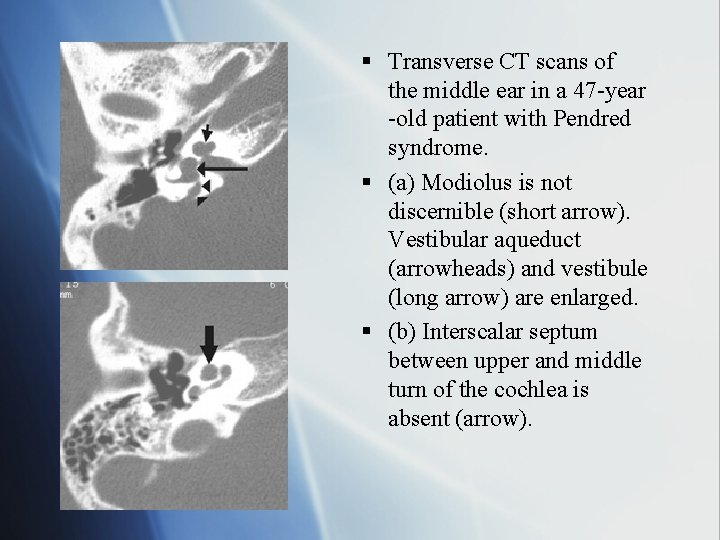 § Transverse CT scans of the middle ear in a 47 -year -old patient