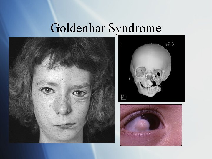 Goldenhar Syndrome 