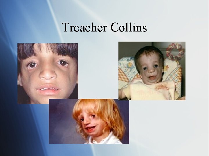 Treacher Collins 