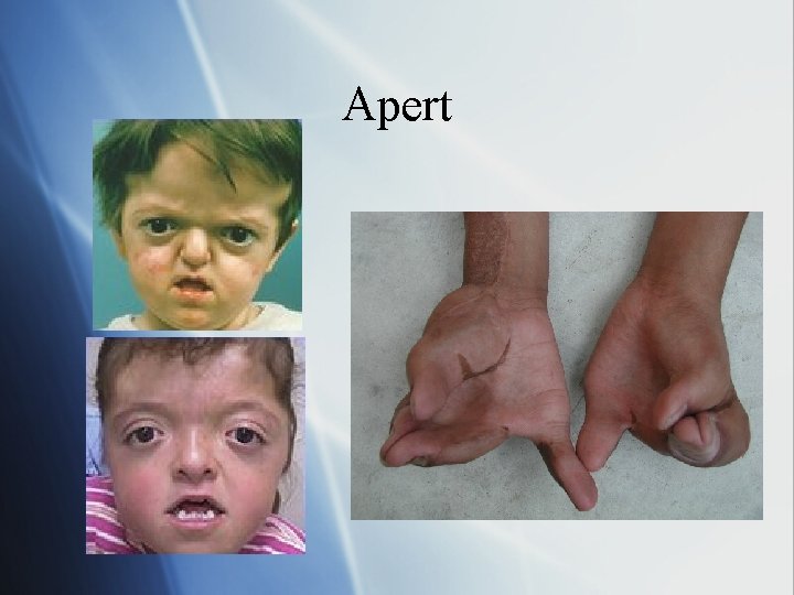 Apert 