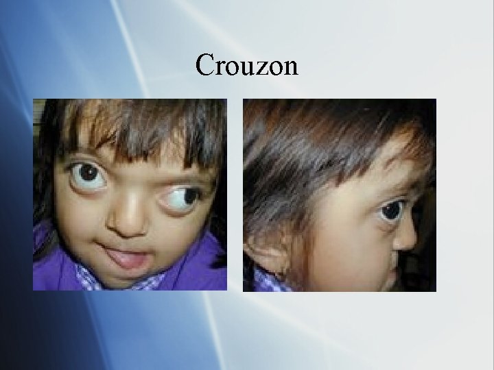 Crouzon 