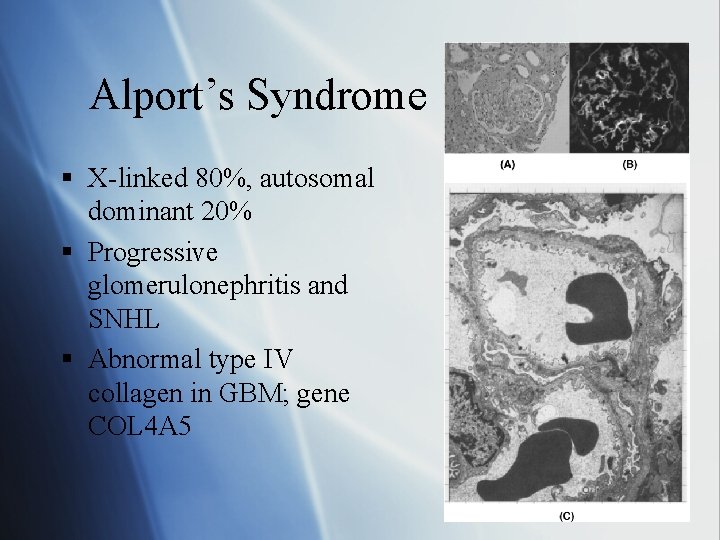 Alport’s Syndrome § X-linked 80%, autosomal dominant 20% § Progressive glomerulonephritis and SNHL §