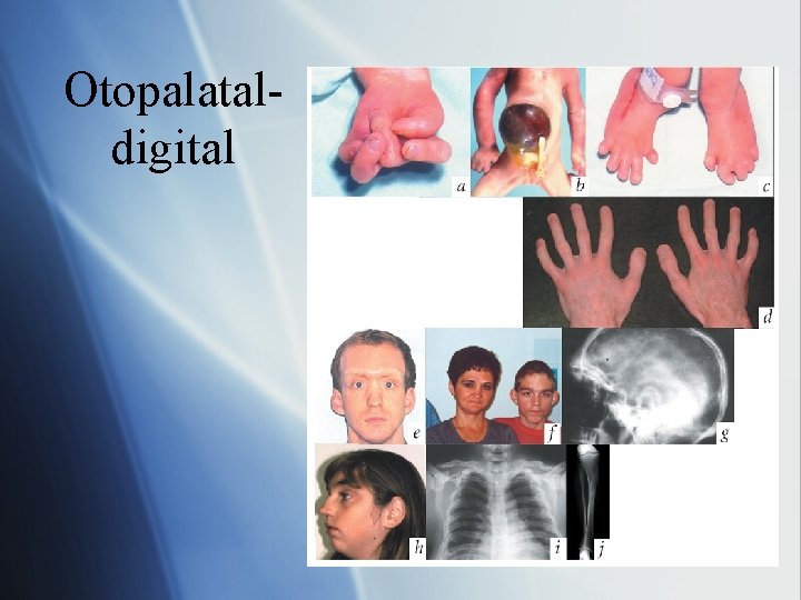 Otopalataldigital 