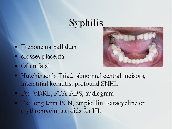 Syphilis § § Treponema pallidum crosses placenta Often fatal Hutchinson’s Triad: abnormal central incisors,