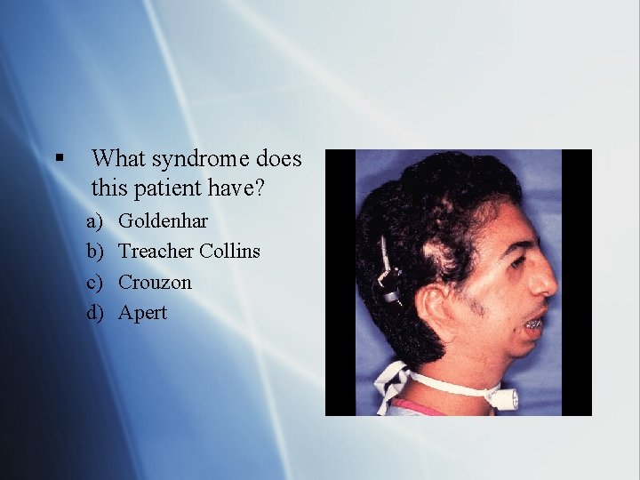 § What syndrome does this patient have? a) b) c) d) Goldenhar Treacher Collins