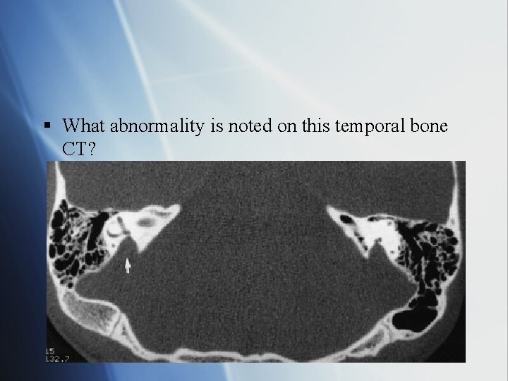 § What abnormality is noted on this temporal bone CT? 