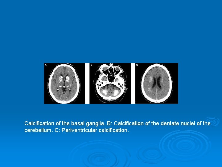 Calcification of the basal ganglia. B: Calcification of the dentate nuclei of the cerebellum.