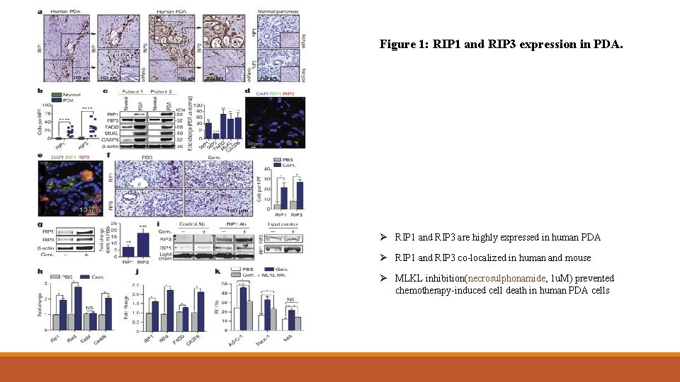 Figure 1: RIP 1 and RIP 3 expression in PDA. Ø RIP 1 and