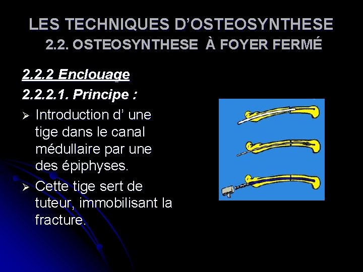 LES TECHNIQUES D’OSTEOSYNTHESE 2. 2. OSTEOSYNTHESE À FOYER FERMÉ 2. 2. 2 Enclouage 2. LES TECHNIQUES D’OSTEOSYNTHESE 2. 2. OSTEOSYNTHESE À FOYER FERMÉ 2. 2. 2 Enclouage 2.