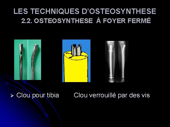 LES TECHNIQUES D’OSTEOSYNTHESE 2. 2. OSTEOSYNTHESE À FOYER FERMÉ Ø Clou pour tibia Clou LES TECHNIQUES D’OSTEOSYNTHESE 2. 2. OSTEOSYNTHESE À FOYER FERMÉ Ø Clou pour tibia Clou