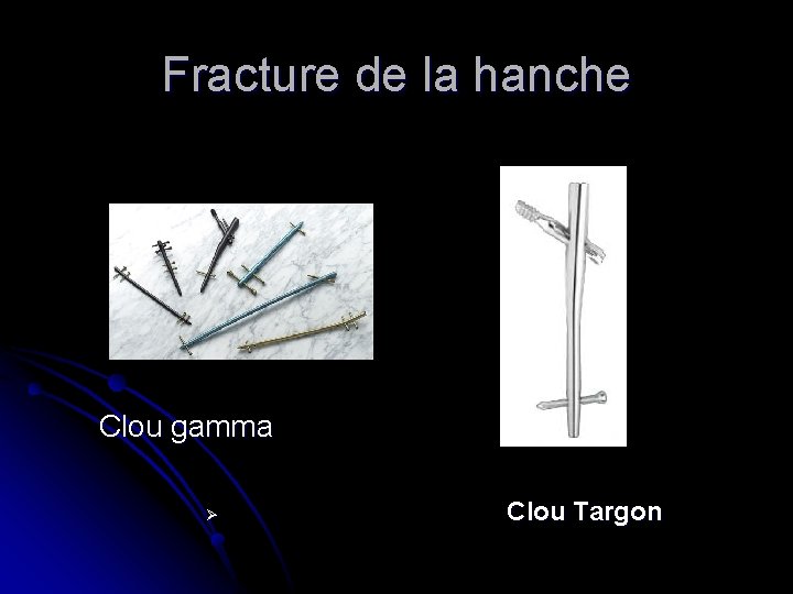 Fracture de la hanche Clou gamma Ø Clou Targon Fracture de la hanche Clou gamma Ø Clou Targon