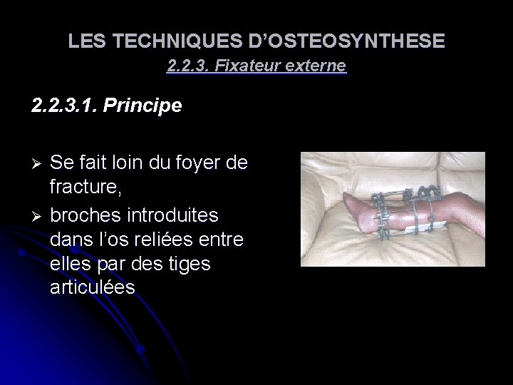 LES TECHNIQUES D’OSTEOSYNTHESE 2. 2. 3. Fixateur externe 2. 2. 3. 1. Principe Ø LES TECHNIQUES D’OSTEOSYNTHESE 2. 2. 3. Fixateur externe 2. 2. 3. 1. Principe Ø