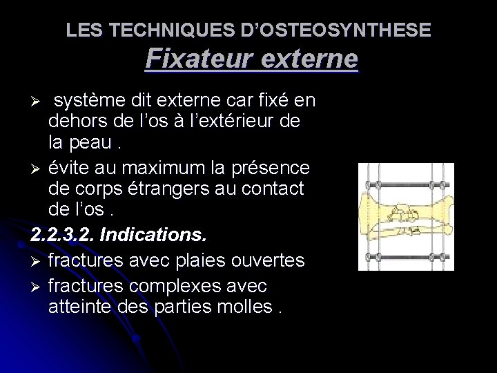 LES TECHNIQUES D’OSTEOSYNTHESE Fixateur externe système dit externe car fixé en dehors de l’os LES TECHNIQUES D’OSTEOSYNTHESE Fixateur externe système dit externe car fixé en dehors de l’os