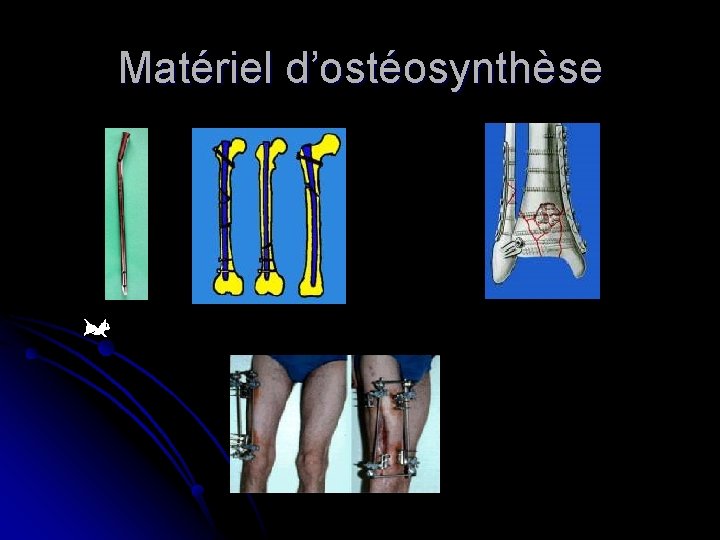 Matériel d’ostéosynthèse Matériel d’ostéosynthèse