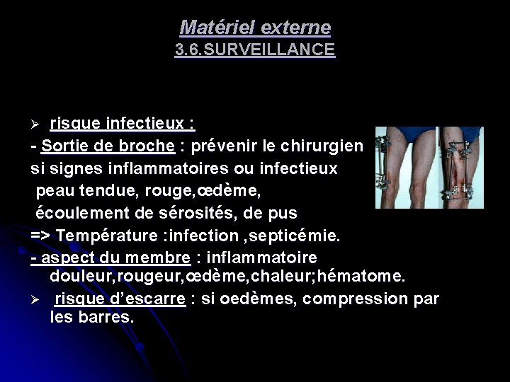 Matériel externe 3. 6. SURVEILLANCE risque infectieux : - Sortie de broche : prévenir Matériel externe 3. 6. SURVEILLANCE risque infectieux : - Sortie de broche : prévenir