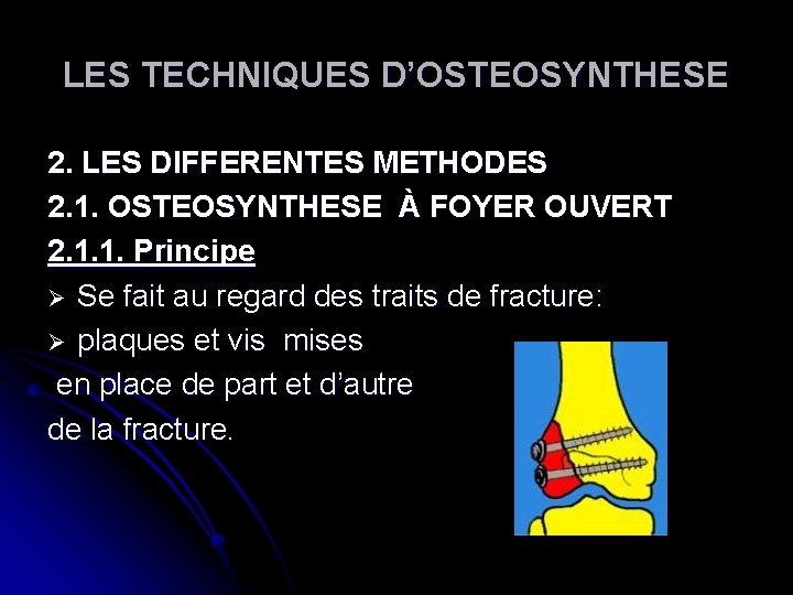 LES TECHNIQUES D’OSTEOSYNTHESE 2. LES DIFFERENTES METHODES 2. 1. OSTEOSYNTHESE À FOYER OUVERT 2. LES TECHNIQUES D’OSTEOSYNTHESE 2. LES DIFFERENTES METHODES 2. 1. OSTEOSYNTHESE À FOYER OUVERT 2.