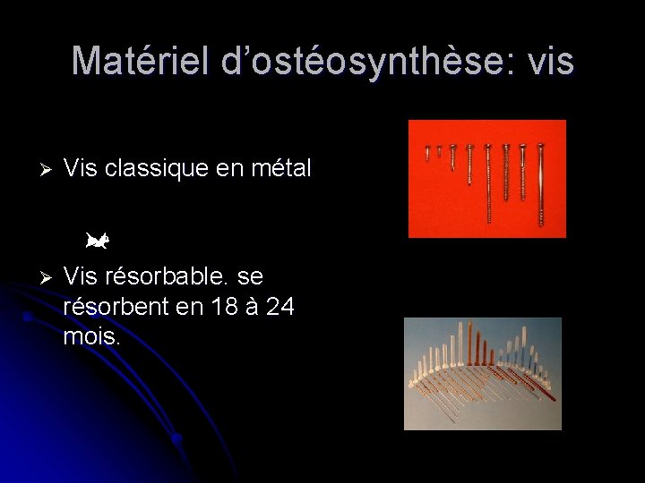 Matériel d’ostéosynthèse: vis Ø Vis classique en métal Ø Vis résorbable. se résorbent en Matériel d’ostéosynthèse: vis Ø Vis classique en métal Ø Vis résorbable. se résorbent en