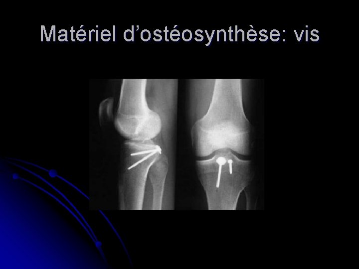 Matériel d’ostéosynthèse: vis Matériel d’ostéosynthèse: vis