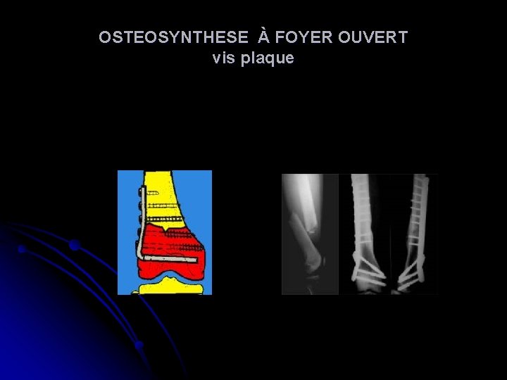 OSTEOSYNTHESE À FOYER OUVERT vis plaque OSTEOSYNTHESE À FOYER OUVERT vis plaque