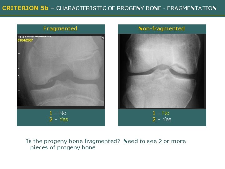 CRITERION 5 b – CHARACTERISTIC OF PROGENY BONE - FRAGMENTATION Fragmented Non-fragmented Need image