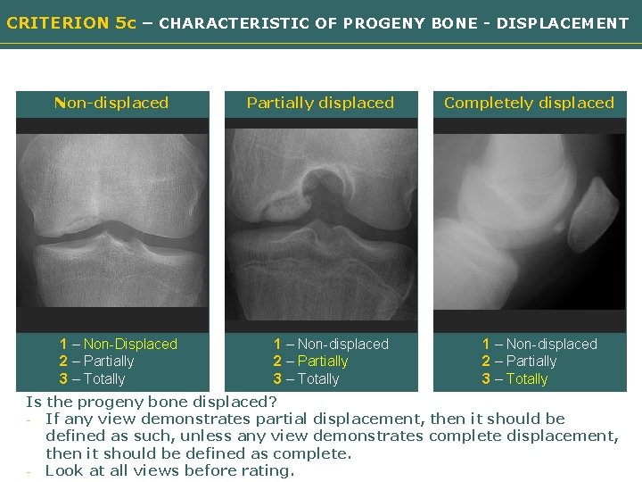 CRITERION 5 c – CHARACTERISTIC OF PROGENY BONE - DISPLACEMENT Non-displaced Partially displaced Need