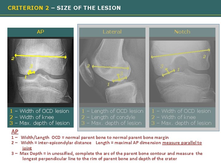 CRITERION 2 – SIZE OF THE LESION AP Lateral Notch 2 2 3 3