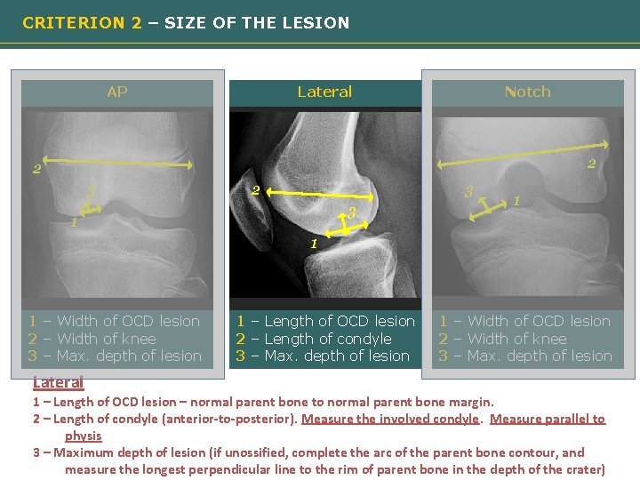 CRITERION 2 – SIZE OF THE LESION AP Lateral Notch 2 2 3 3