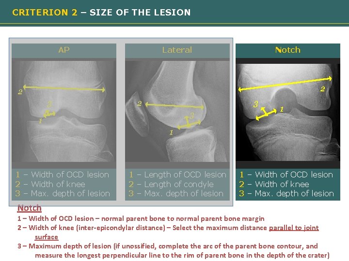 CRITERION 2 – SIZE OF THE LESION AP Lateral Notch 2 2 3 3