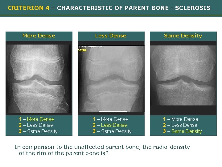 CRITERION 4 – CHARACTERISTIC OF PARENT BONE - SCLEROSIS More Dense Less Dense Need