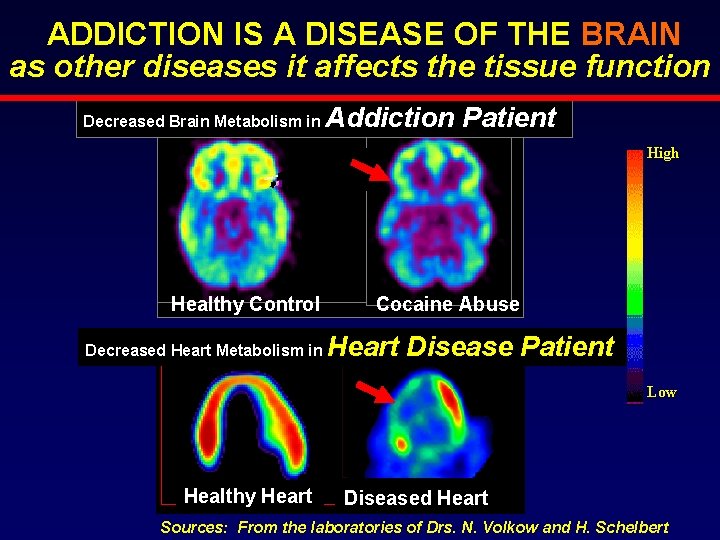 ADDICTION IS A DISEASE OF THE BRAIN as other diseases it affects the tissue ADDICTION IS A DISEASE OF THE BRAIN as other diseases it affects the tissue