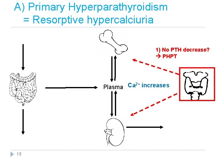 A) Primary Hyperparathyroidism = Resorptive hypercalciuria 1) No PTH decrease? PHPT 2+ Plasma Ca