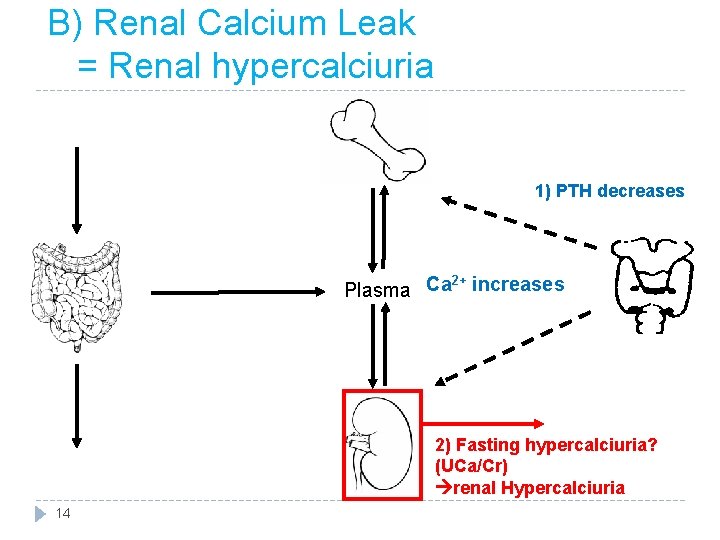 B) Renal Calcium Leak = Renal hypercalciuria 1) PTH decreases 2+ Plasma Ca increases