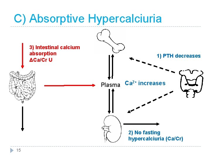 C) Absorptive Hypercalciuria 3) Intestinal calcium absorption ΔCa/Cr U 1) PTH decreases 2+ Plasma