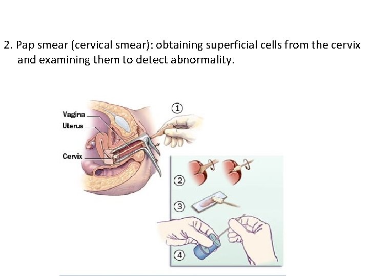 2. Pap smear (cervical smear): obtaining superficial cells from the cervix and examining them