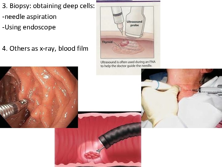 3. Biopsy: obtaining deep cells: -needle aspiration -Using endoscope 4. Others as x-ray, blood