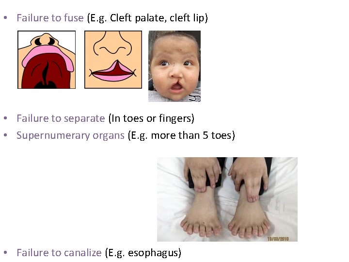 • Failure to fuse (E. g. Cleft palate, cleft lip) • Failure to